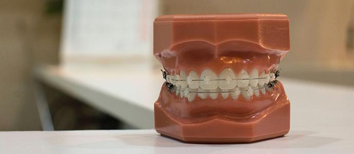 牙齿雕塑上的牙套